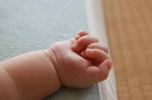 Bayi Bermata Satu Lahir di Sumatera Utara